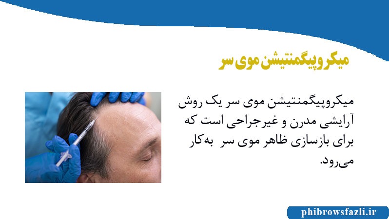 میکروپیگمنتیشن موی سر