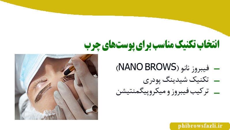 انتخاب تکنیک مناسب برای پوست‌های چرب