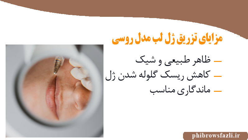 مزایای تزریق ژل لب مدل روسی